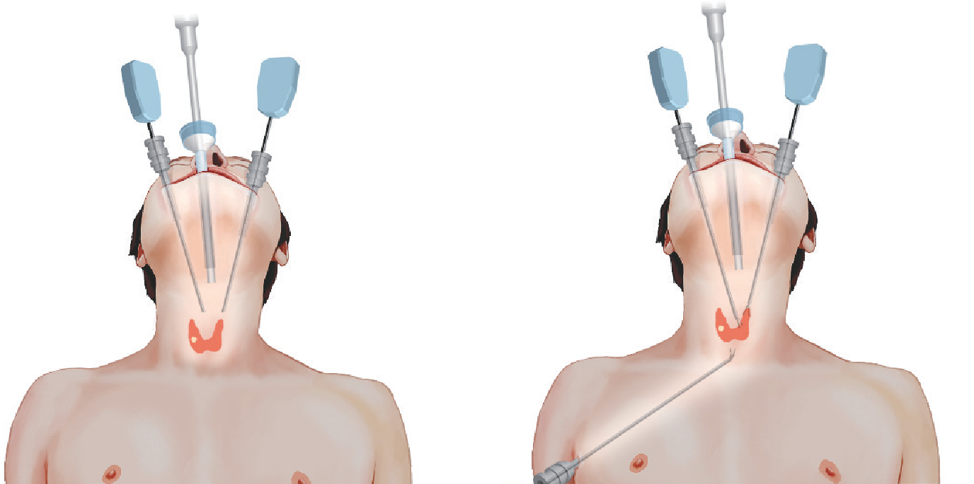 Endoscopic / Scarless Thyroidectomy
