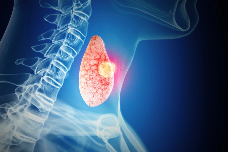 Thyroid Cancer