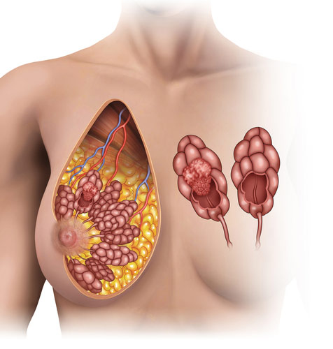 Mastalgia and other diseases of Breast