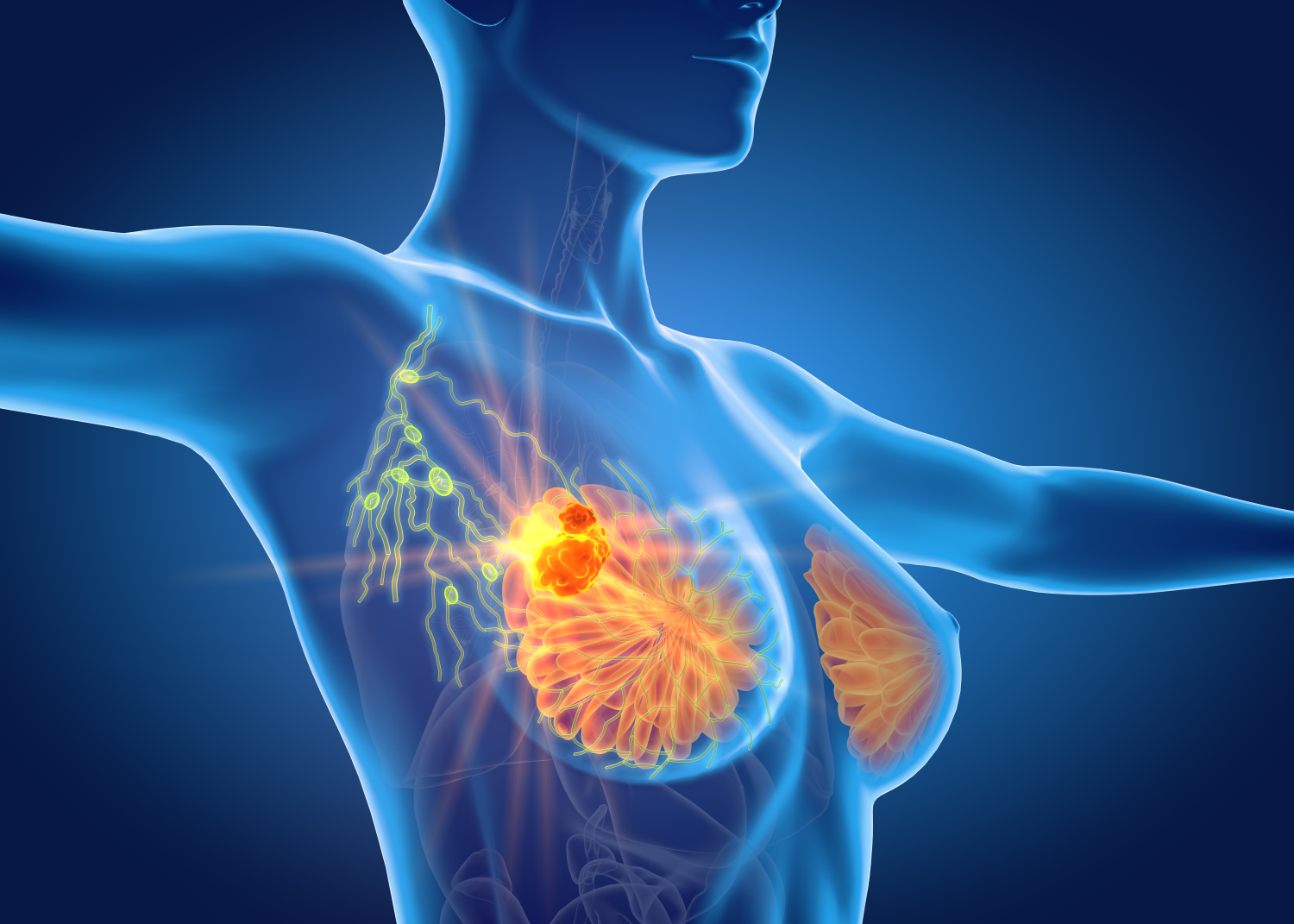 Breast Oncoplastic Surgery